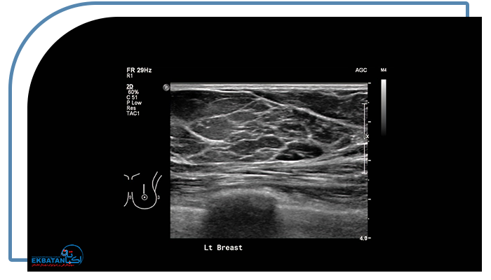 عکس سونوگرافی سینه