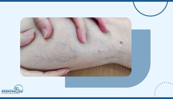 آیا رگ‌های عنکبوتی پا خطرناک هستند یا فقط زیبایی را تحت تأثیر می‌گذارند؟