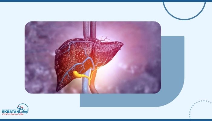 آیا فیبرواسکن می‌تواند مراحل اولیه سیروز را شناسایی کند؟