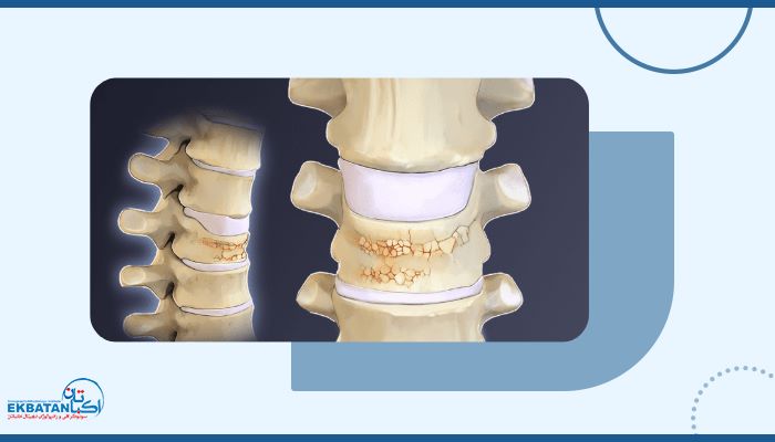 آیا پوکی استخوان میتواند باعث انحراف در ستون فقرات بشود؟