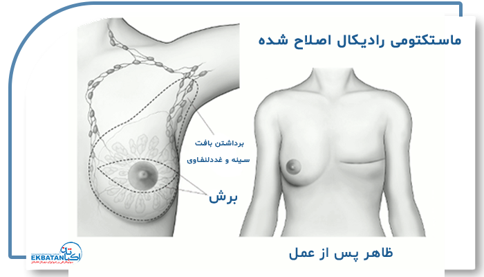 روش های جراحی پستان