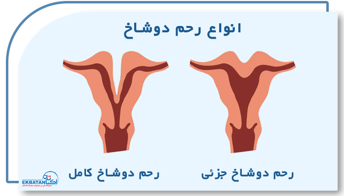 انواع رحم دوشاخ