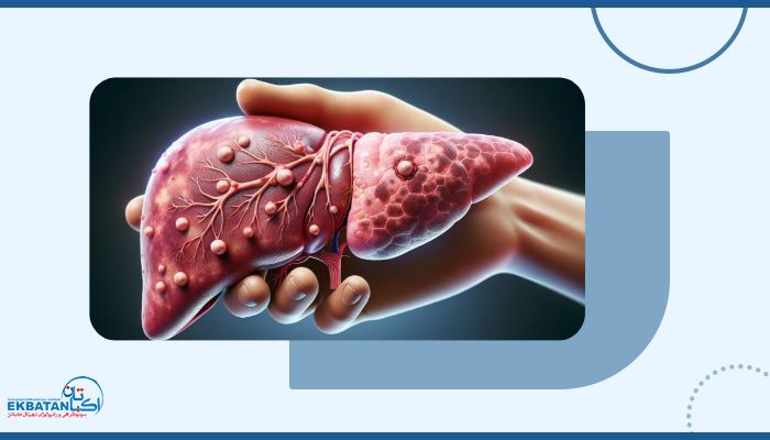 برای تشخیص سیروز و نارسایی کبد چه روشی بهترین انتخاب است؟ 