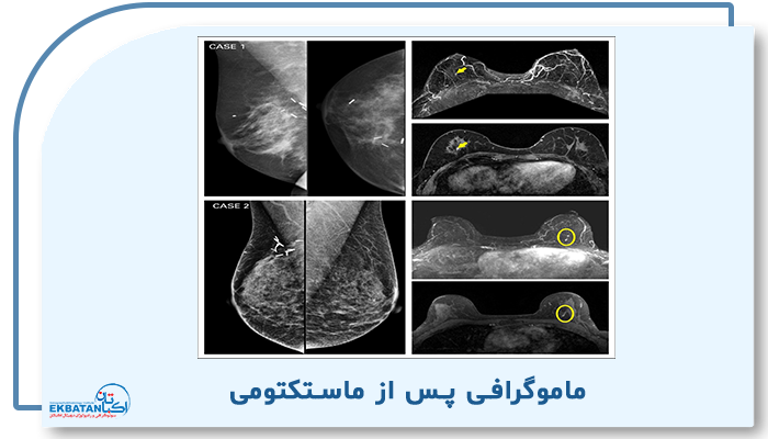 ماموگرافی پس از جراحی