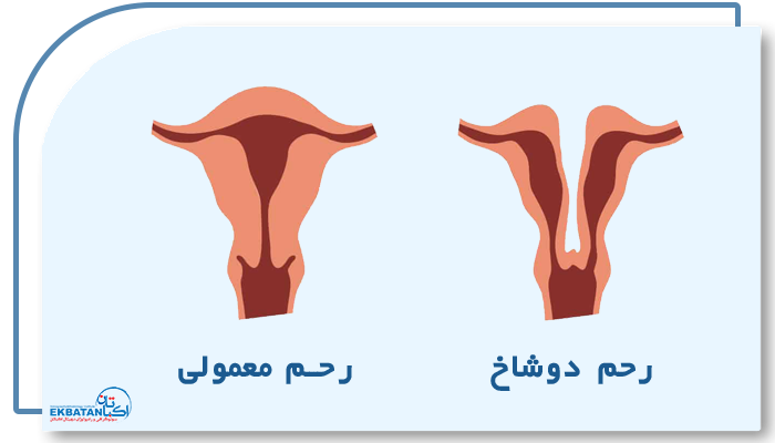 عکس رحم دوشاخ