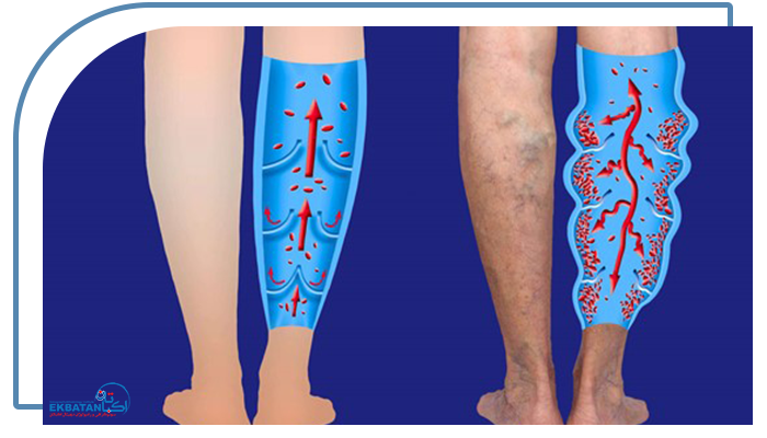 روش های درمان واریس