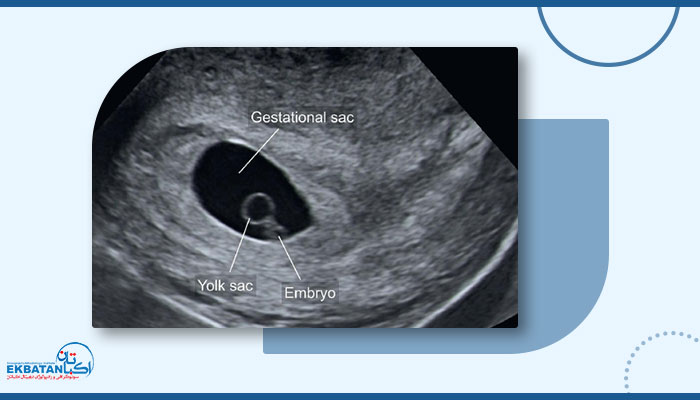 سونوگرافی جهت تعیین وجود ساک حاملگی