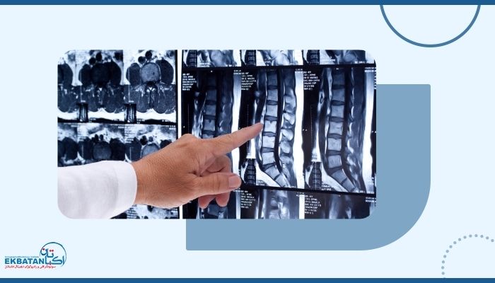 علائم سرخوردگی مهره کمر چیست و چگونه میتوان آن را تشخیص داد؟