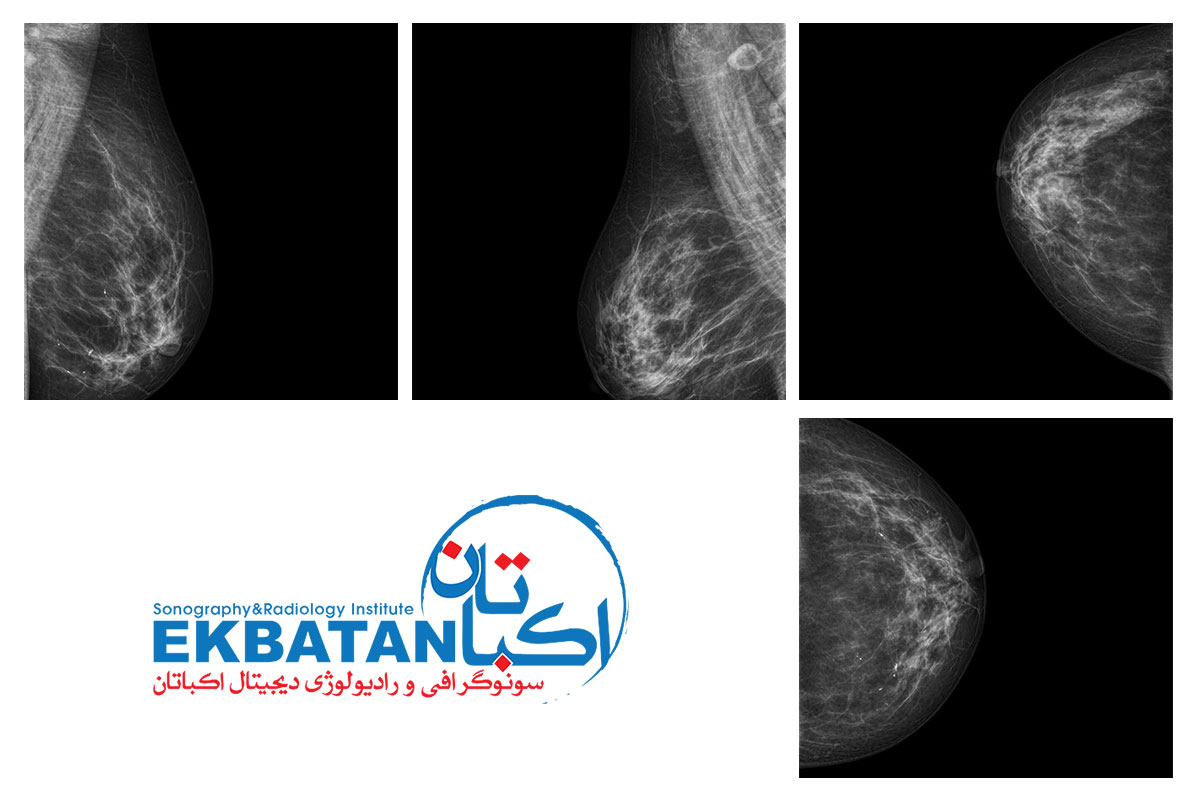 چند نمونه از نتایج تست Mammography