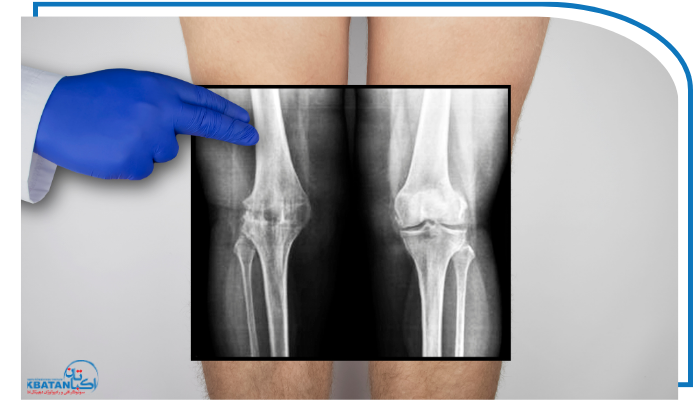 کجی زانو تا چه حد خطرناک است و چگونه تشخیص داده می‌شود؟